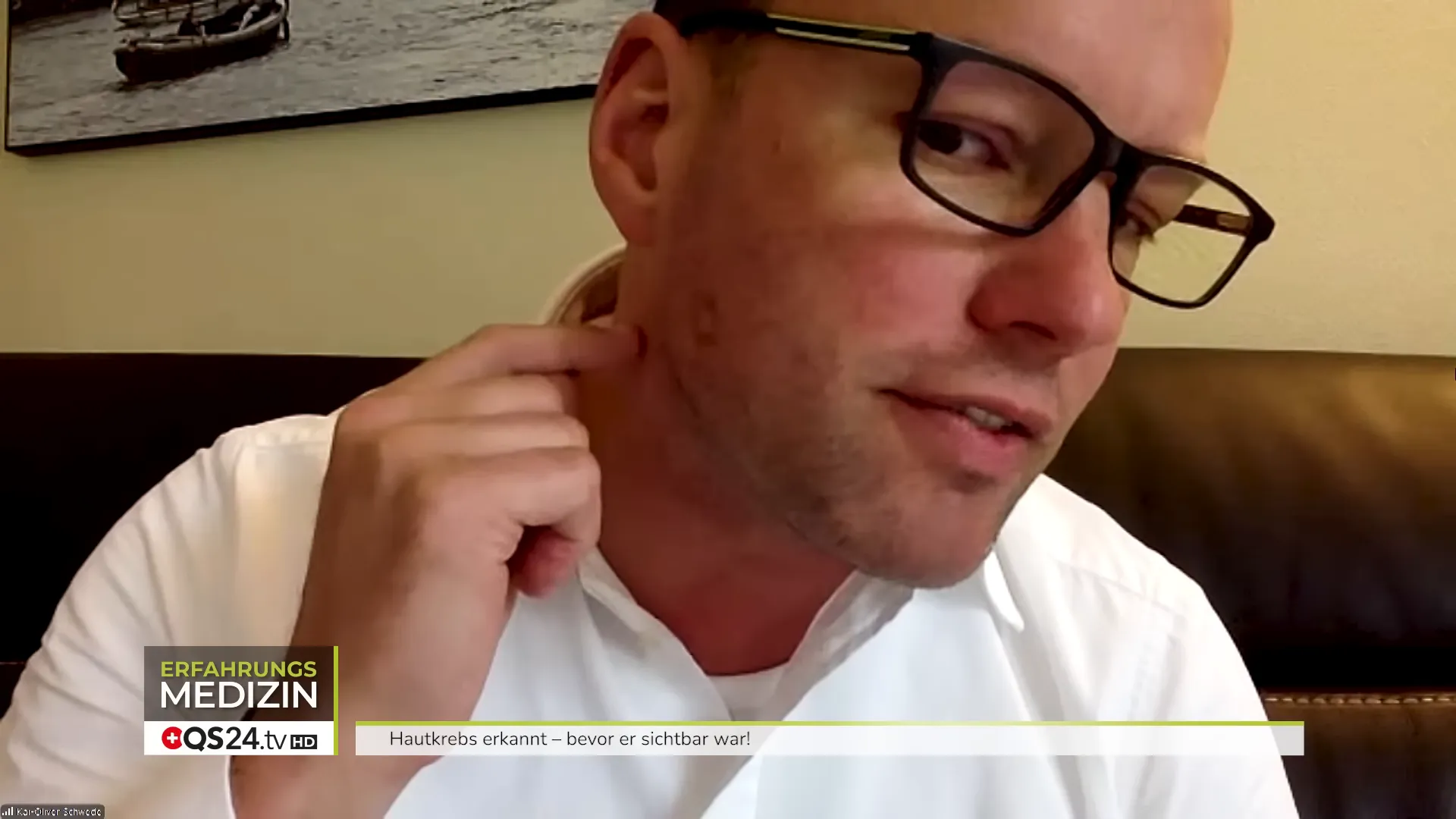 Ein Patient zeigt die Stelle des späteren Basalioms an der Wange