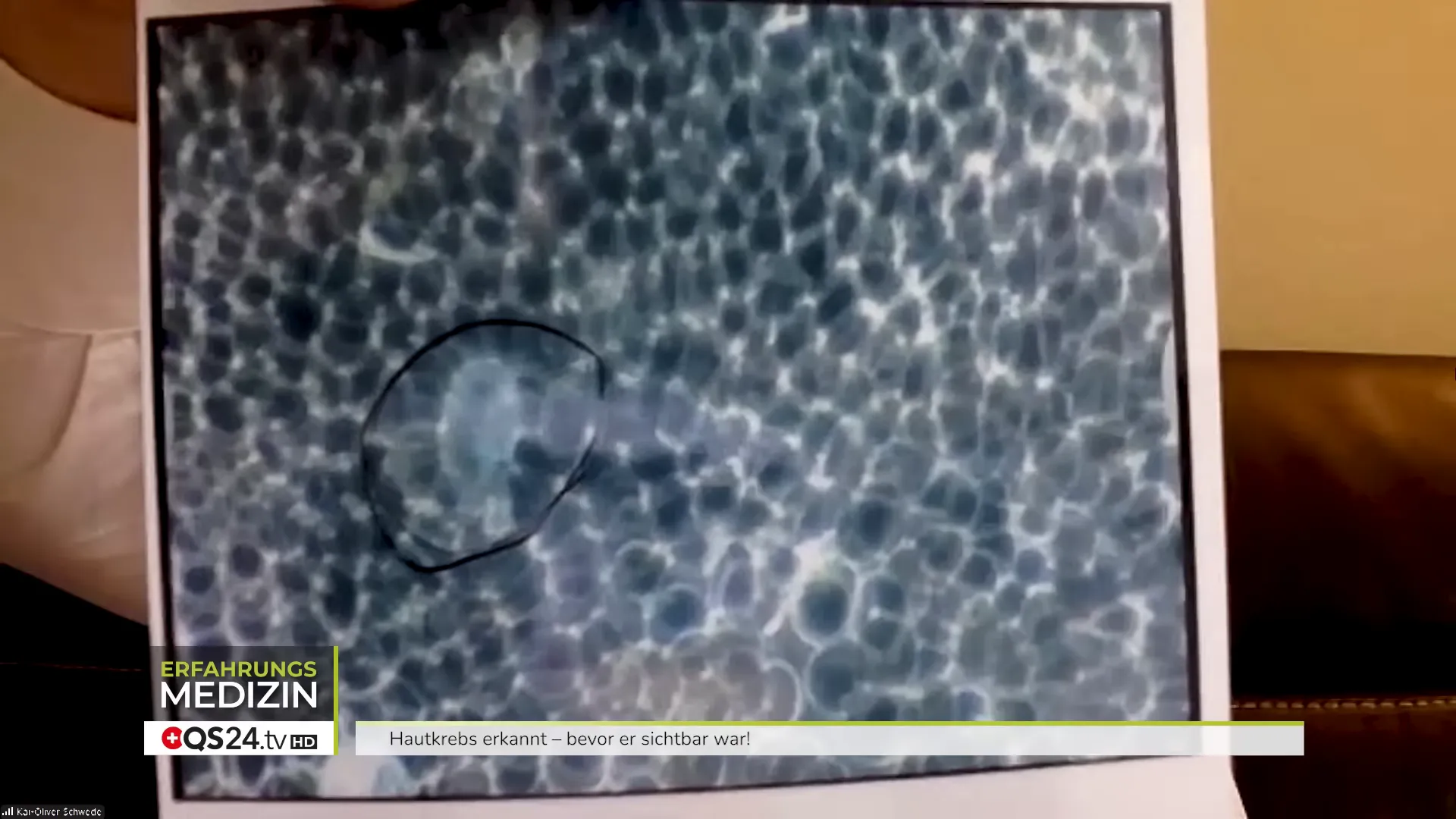 Dunkelfeldaufnahme: veränderte Blutbilder mit präkanzerösen Zellen